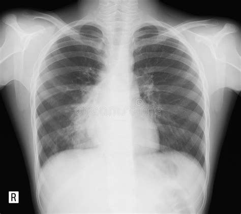 X Ray Of The Lungs Bronchopneumonia Child Stock Photo Image Of