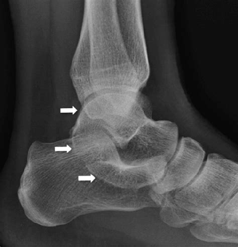 Tarsal Coalitions Foot And Ankle Clinics