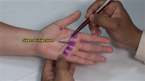 Flexor Tendonitis Hand Injection Youtube