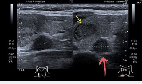 Ultrasound Of The Neck Showing Right Thyroid Lobe Nodule Arrow In
