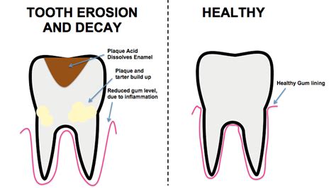 What Is A Cavity Exactly Dental Health Society