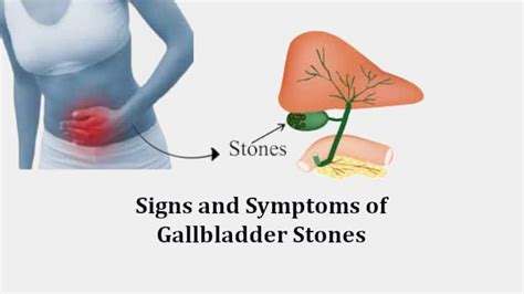 10 Warning Signs And Symptoms Of Gallbladder Stones