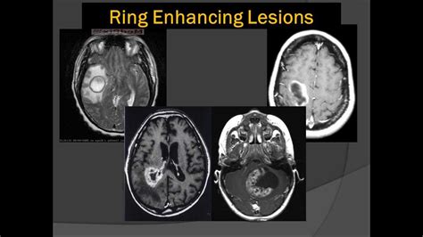 Brain Scans Lord Of The Ring Enhancing Lesions 101 Youtube