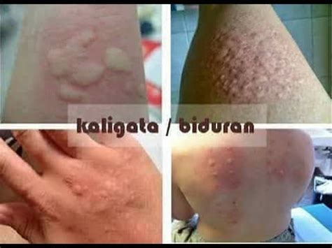 Cara Menghilangkan Gatal Di Badan Secara Alami - YouTube
