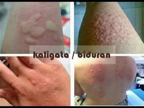 Jadi, minyak kelapa ini bisa menjadi solusi bagi kamu yang sedang mengalami kulit gatal, karena berbahan alami minyak ini aman untuk digunakan kapan saja. Cara Menghilangkan Gatal Di Badan Secara Alami - YouTube