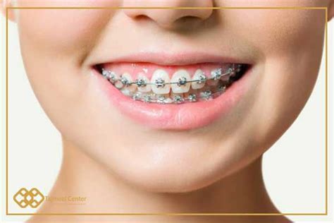 Types Of Orthodontics With Pictures And Prices