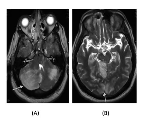 Mri Brain A Acute Arterial Infarction Of Bilateral Cerebellar