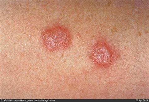 Stock Image Close Up Of Erythema Multiforme Showing Raised Red Lesions