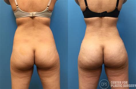 Brazilian Butt Lift Washington DC Chevy Chase Center For Plastic Surgery