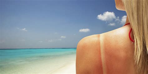 What Actually Happens When You Get A Sunburn HuffPost