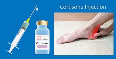 Foot And Ankle Cortisone Injection Musculoskeletal Ultrasound