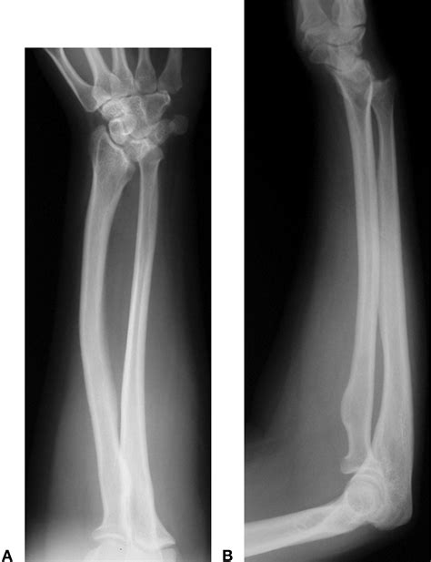 Madelungs Deformity A Spectrum Of Presentation Journal Of Hand Surgery