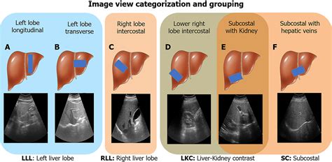 Accurate And Generalizable Quantitative Scoring Of Liver Steatosis From Ultrasound Images Via