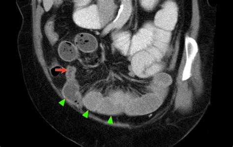 The Radiology Assistant Closed Loop Obstruction In Small Bowel