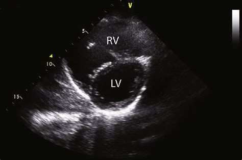 Echocardiogram Of Case 5 Demonstrating An Enlarged Right Ventricle Rv