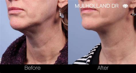Toronto Neck Lift And Double Chin Clinic Spamedica
