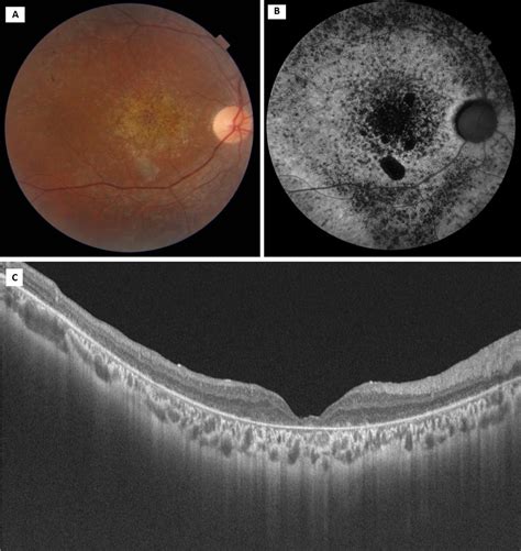 Focal Choroidal Excavation In Stargardts Dystrophy Bmj Case Reports