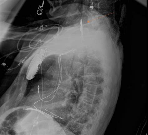 Cureus A Hard Case To Swallow Crucifix Esophageal Foreign Body In A