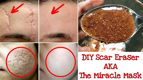 Because of this, old, stubborn scars start to fade and become lighter. DIY Scar Eraser AKA The Miracle Mask | Dark Spots, Acne ...