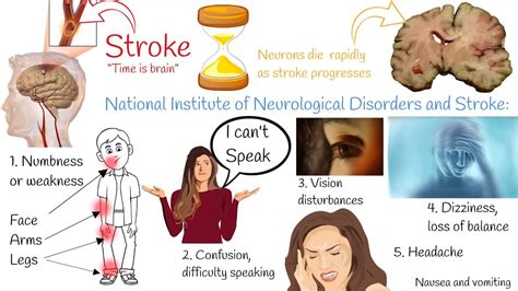 Stroke Ischemic Stroke Symptoms And Treatment Hemorrhagic Stroke