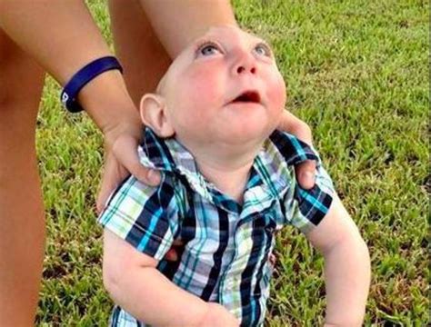 This ‘brainless Baby Defied Odds By Reaching His First Birthday