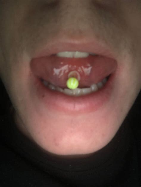I Got My Tongue Pierced One Month And 2weeks Ago And I Dont Know What This Is Can Anyone Help
