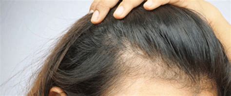 Alopécie Ou Chute De Cheveux Dr Corinne Potet à La Baule