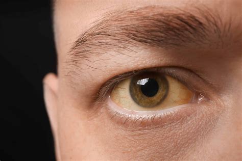 Are Yellow Eyes From Drinking Alcohol Phoenix Rising Recovery