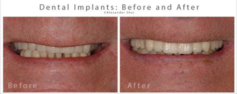 Maybe you would like to learn more about one of these? Dental Implants Before & After Seattle - Shor Dental