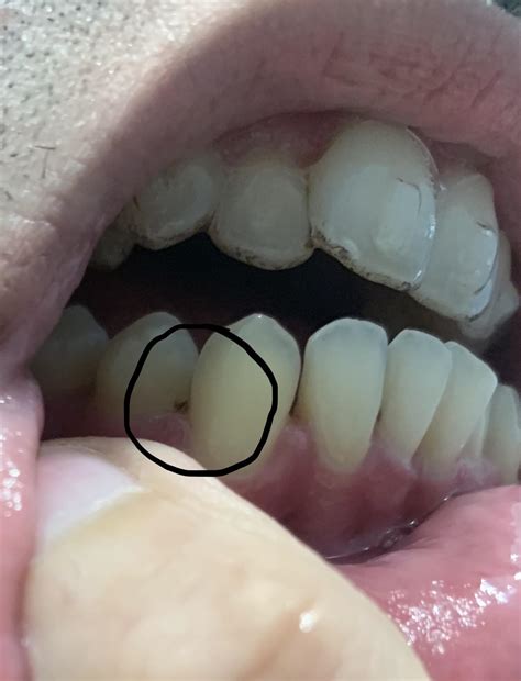 Dark Spot On Front Tooth Near Gum Line Invisalign