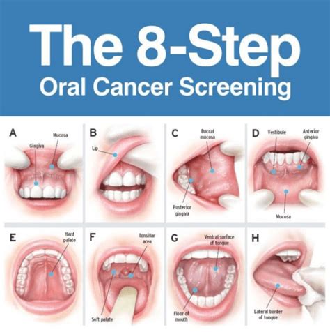 Oral Cancer Self Examination Essex Viva Dental Studio