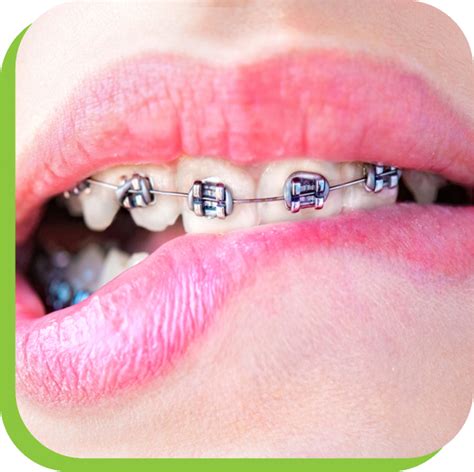 Braces Emergencies Gardner And La Rochelle Orthodontics