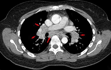 Sarcoidosis Wikiwand