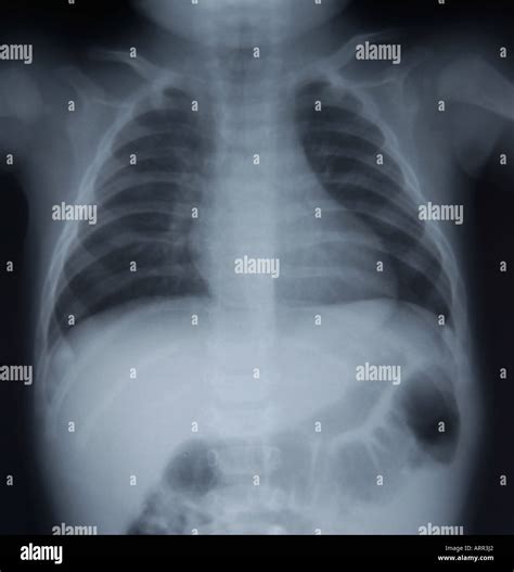 Frontal View Of Normal Pediatric Chest X Ray Stock Photo Alamy