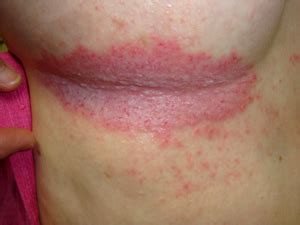 Blister on buttocks could be caused by a number of possible reason. Sore In The Crack Of My Buttocks - bestiload
