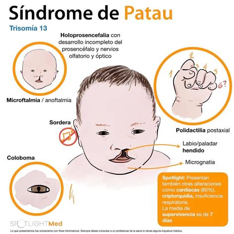 O Que E Sindrome De Patau