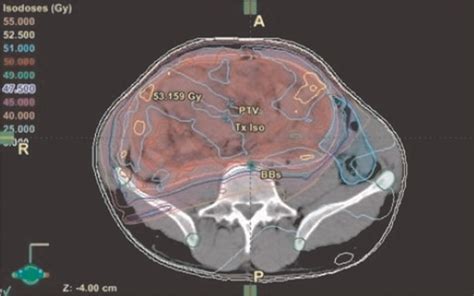 Role Of Radiation Therapy In Retroperitoneal Sarcoma In Journal Of The