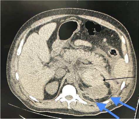 Pre Operative Ct Black Arrow Showing A Left Suprarenal Hyperdense