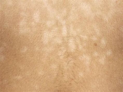 Why Most People Fail At Trying To Treat Tinea Versicolor Healthtian