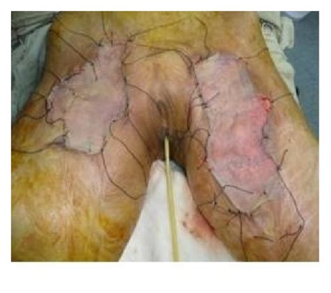Inguinal hernias arise above this ligament and it plays a pivotal role in the causation of groin pain. Figure 7 | Outcome of Split Thickness Skin Grafting and ...