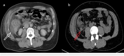 A Axial Non Contrasted Abdominal Ct Scan Showing A Collection