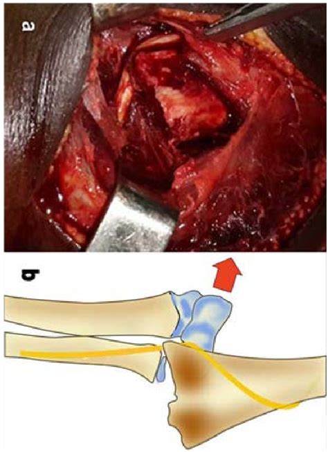 Per Operative A And Illustration B Images Showing The Radial Nerve