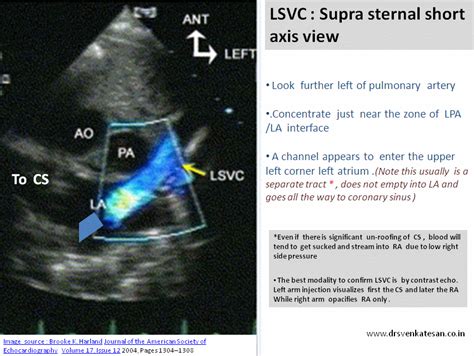 Bicuspid Aortic Valve Atrial Septal Defect Cardiac Sonography