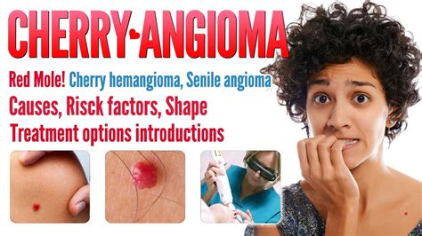 Cherry Angioma Causes Shapes And Treatment Options Red Mole Cherry