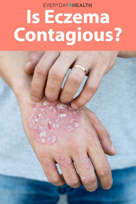 Is Eczema Contagious 2 Skincare Experts Weigh In In 2020 How To Make
