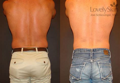 Coolsculpting Before And After Photos Skin Specialists