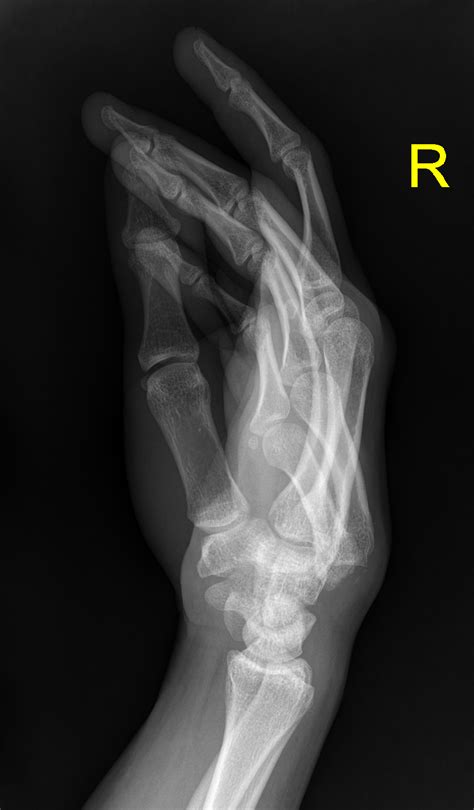 Fourth And Fifth Carpometacarpal Joint Dislocations Image