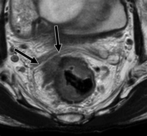 Restaging Of Rectal Cancer With Mr Imaging After Concurrent