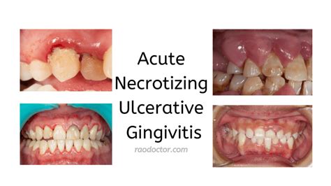 Acute Necrotizing Ulcerative Gingivitis 8 Signs And Symptoms