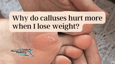 Why Do Calluses Hurt More When I Lose Weight Central Massachusetts